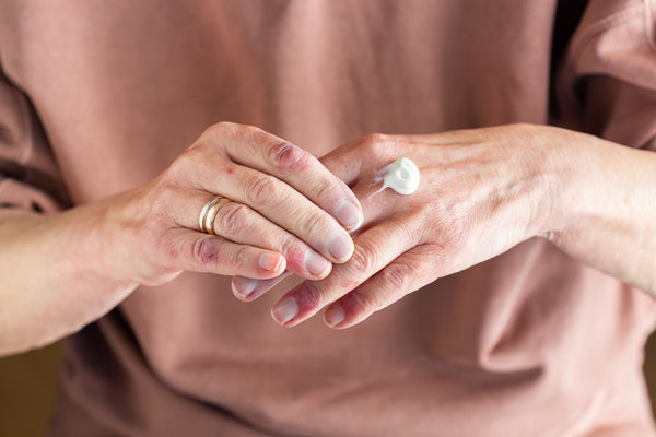 Applying ointment to hands with atopic dermatitis, eczema, allergy