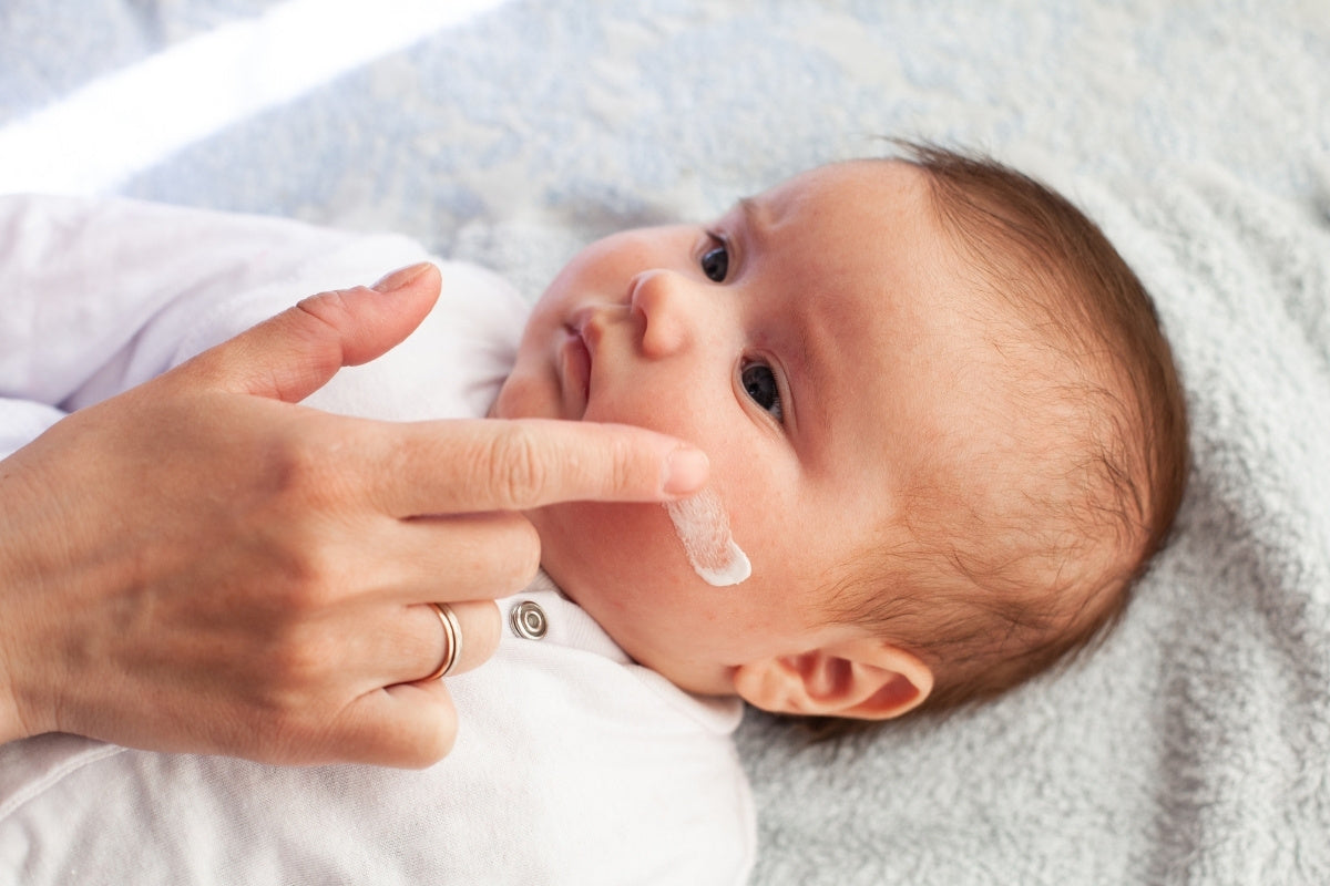 baby with eczema