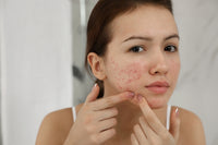 How to Manage Acne-Prone Skin in Singapore’s Hot and Humid Climate